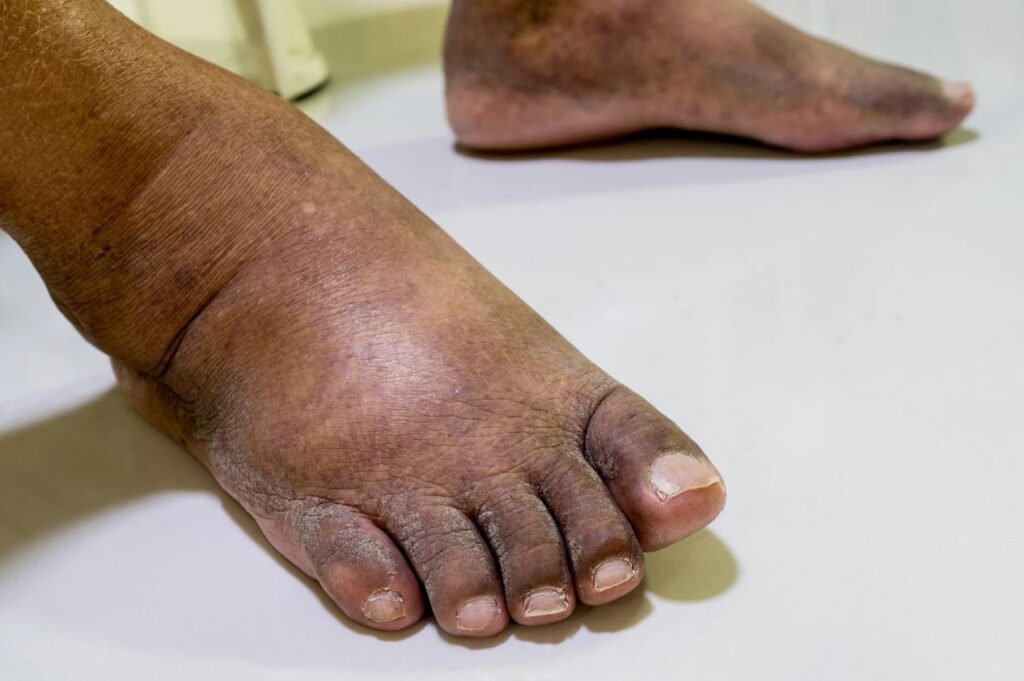 How can diabetes affect circulation in the feet, and what can be done about it?
