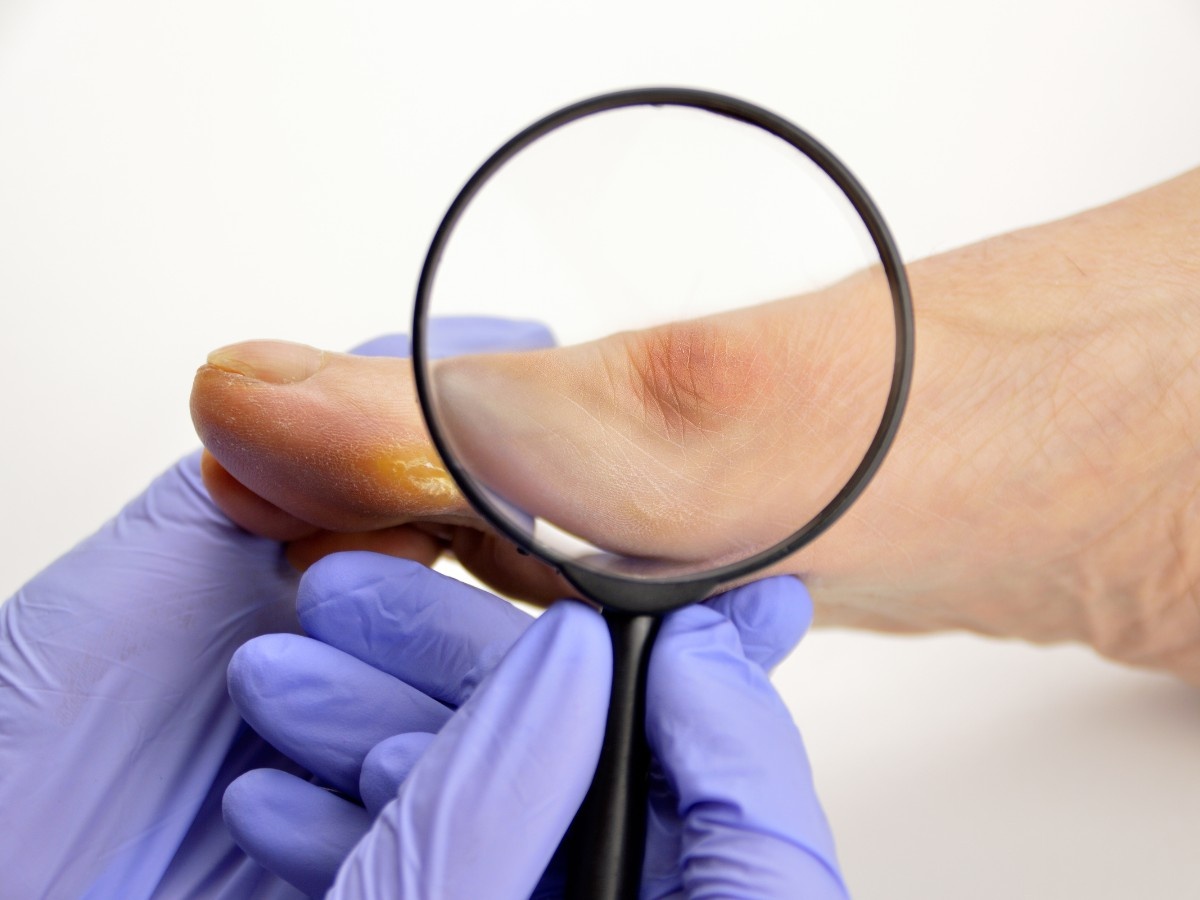 A doctor examining bunion for surgery in Silverglen North