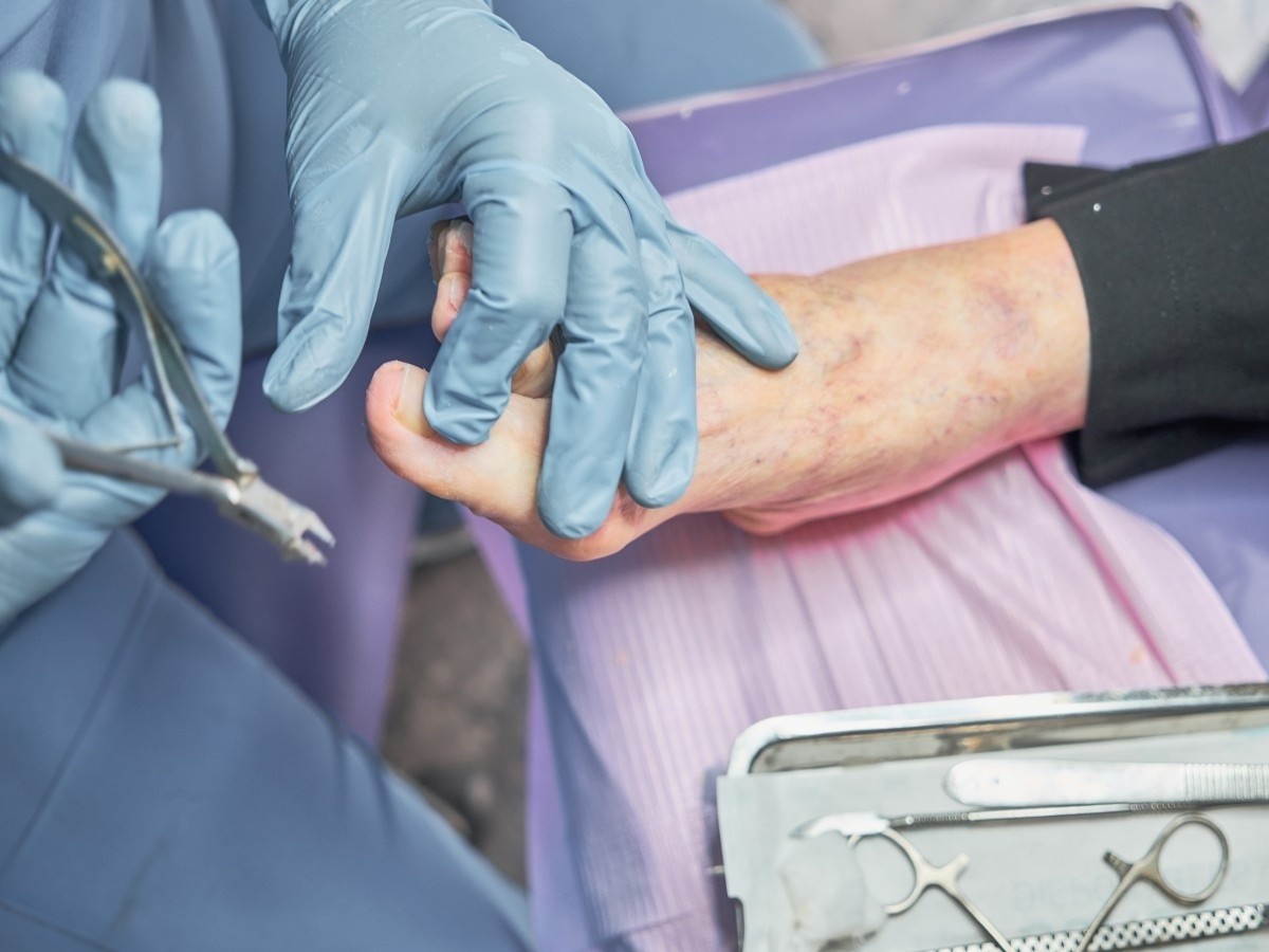 A podiatrist preparing to remove a toenail from a patient’s foot in Timber Meadow.