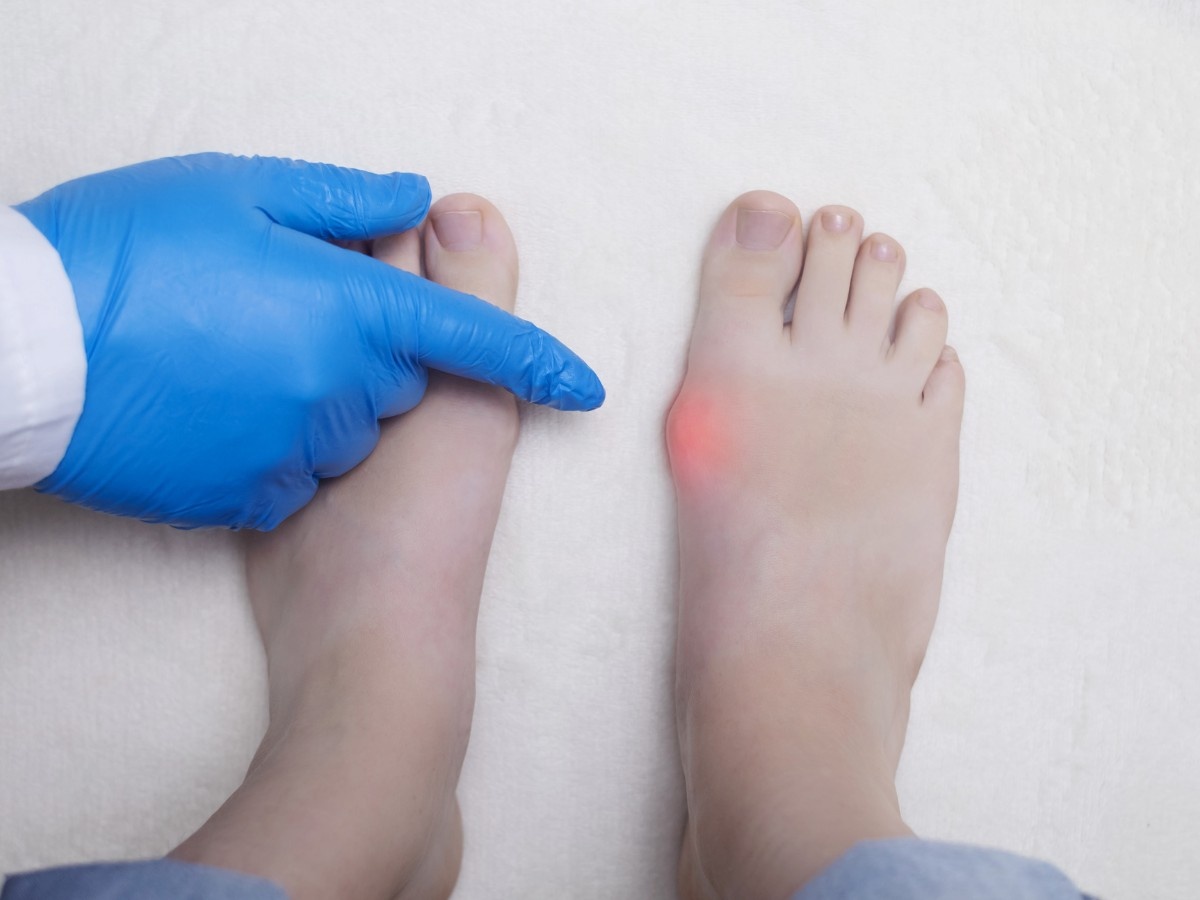 A podiatrist checking a bunion on a patient in Laurel Oaks.