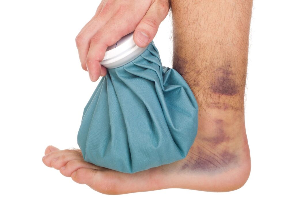 A patient with a severely bruised ankle applies an ice pack, indicating a need for an emergency podiatrist in Houston.