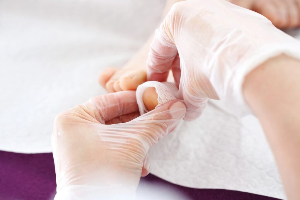 Podiatrist ingrown toenail care with sterile bandage application to protect toe and support healing in clinical setting.