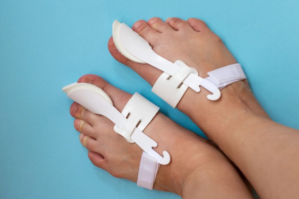 Bunion surgery doctors use orthopedic correctors to support toe alignment and reduce pain from bunion deformities.
