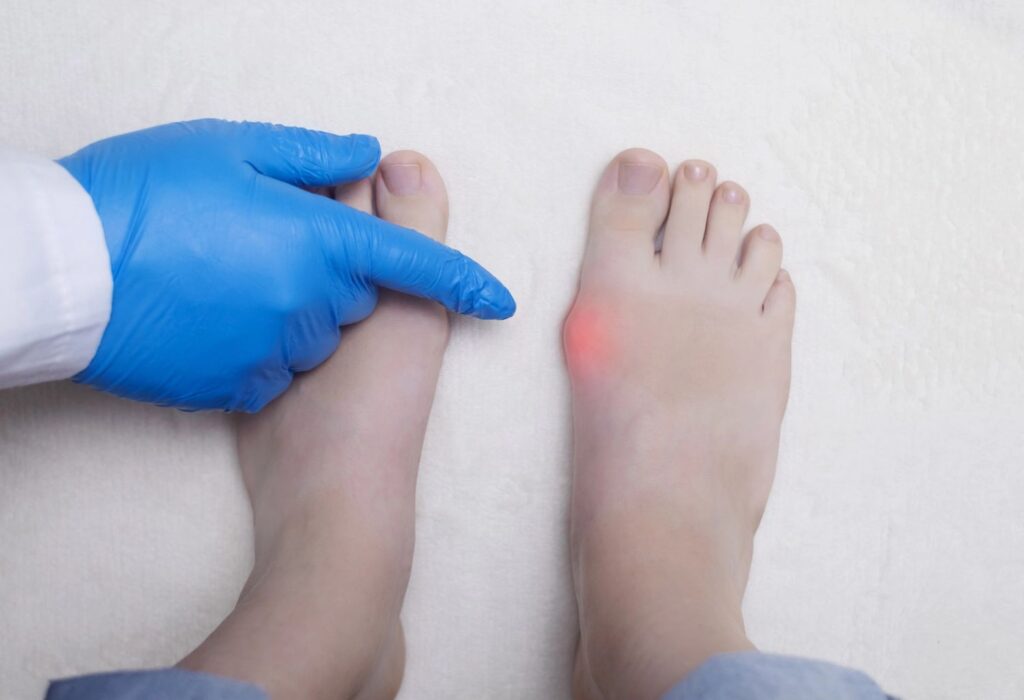 Bunion surgery doctors assess inflammation and pain near big toe to determine treatment options for foot conditions.