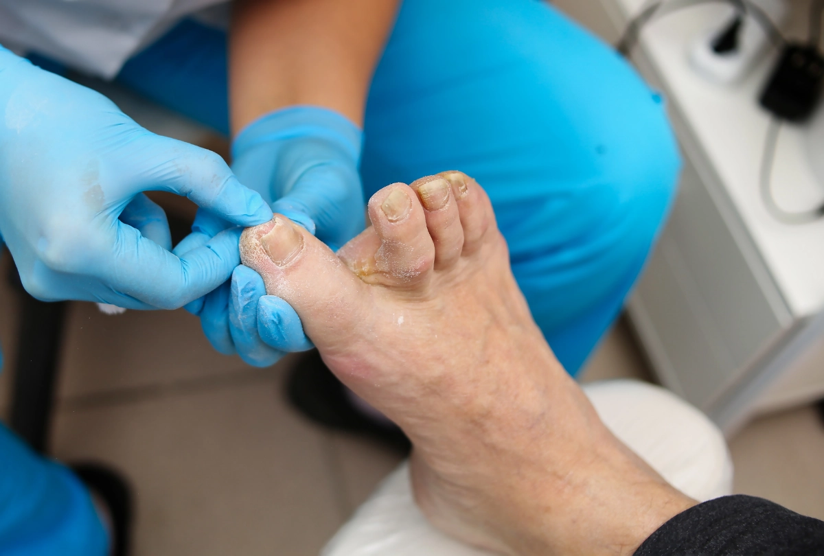 Heel Pain Treatment Cypress offers expert care for thick toenails and dry skin. Clinical foot exam shown in close-up.