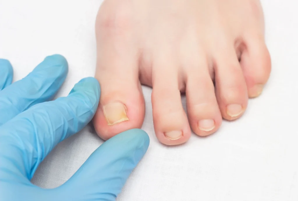 Toe Doctors Cypress examine discolored toenail for infection or ingrown nail. Expert care shown in clinical close-up.