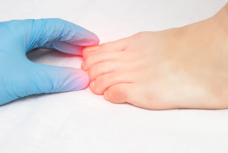 Toenail Fungus Doctors Cypress examine inflamed big toe for fungal infection or joint pain. Clinical care shown in close-up.
