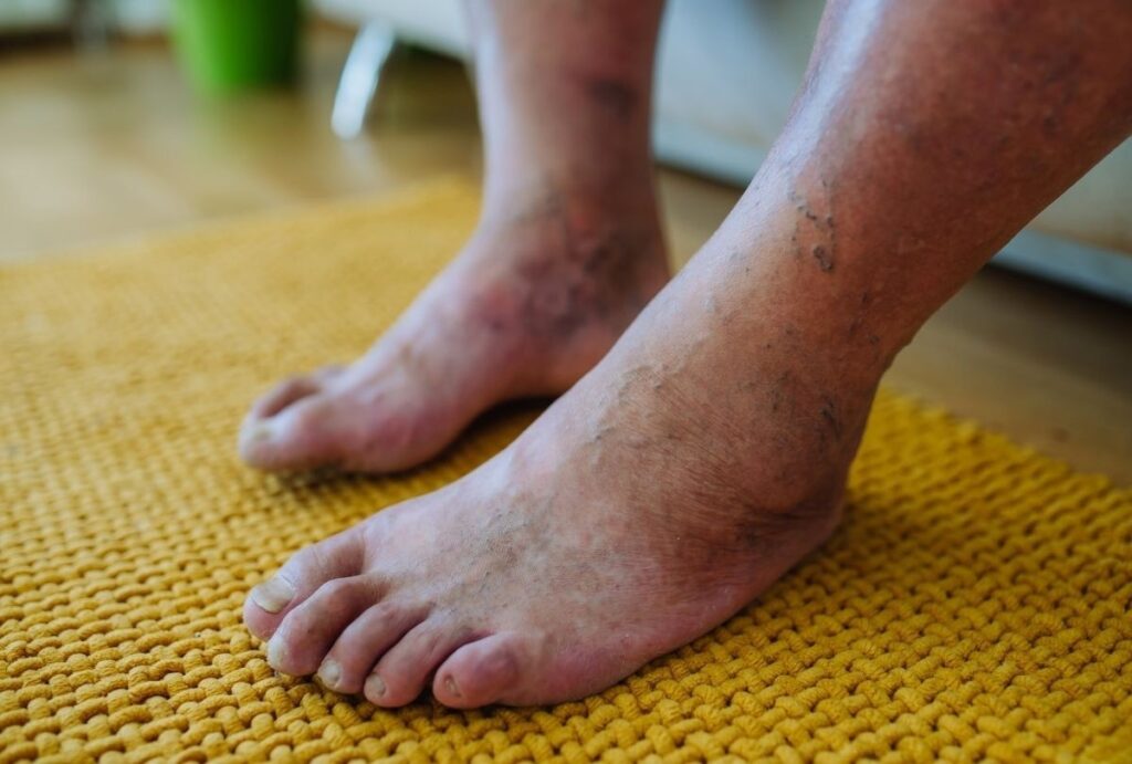 Discolored feet and veins shown during Diabetic Foot Care Treatment Cypress for vascular health evaluation