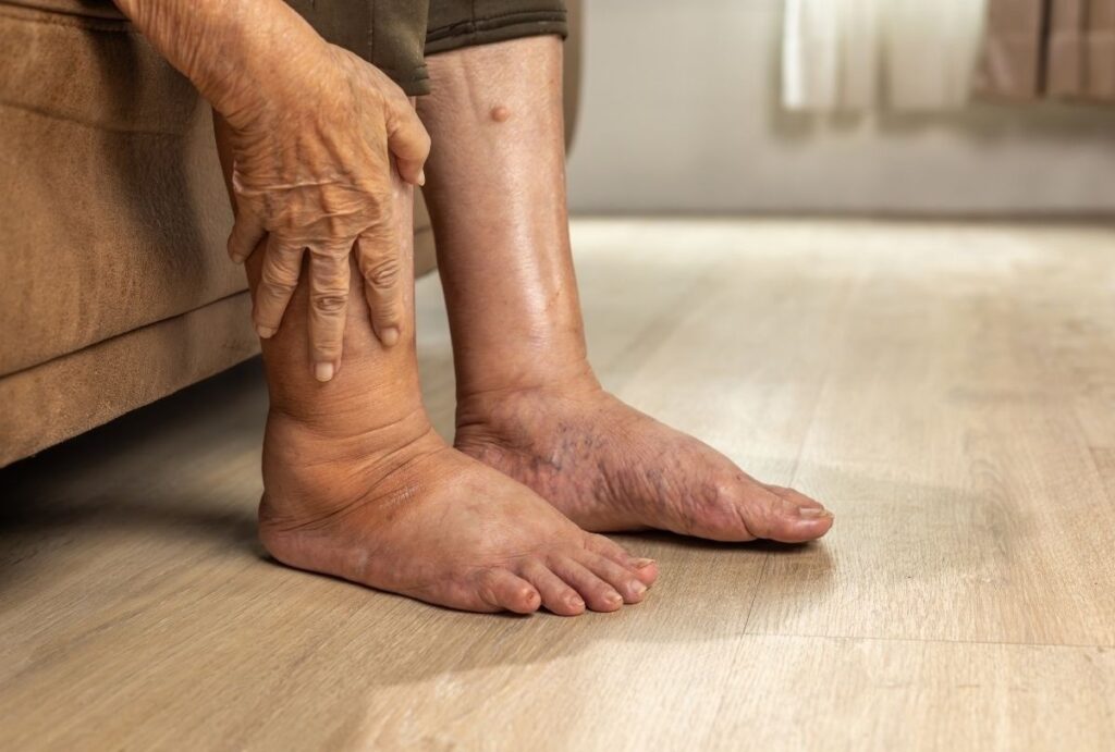 Swollen ankle examined during Diabetic Foot Care Treatment Cypress to assess edema and venous insufficiency