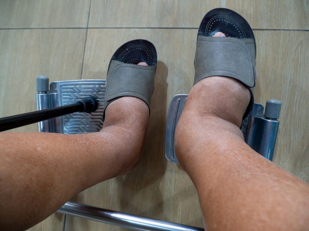 Swollen feet supported in wheelchair during Diabetic Wound Care Doctor Cypress evaluation for mobility and edema