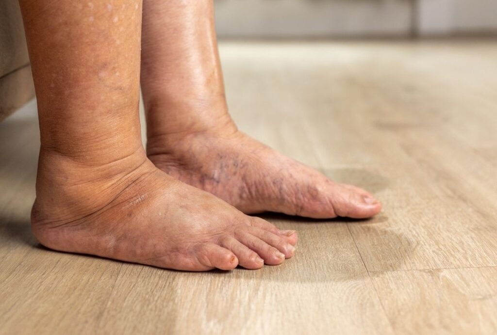 Visible signs of venous issues in patient’s legs during Diabetic Foot Care Treatment Cypress evaluation