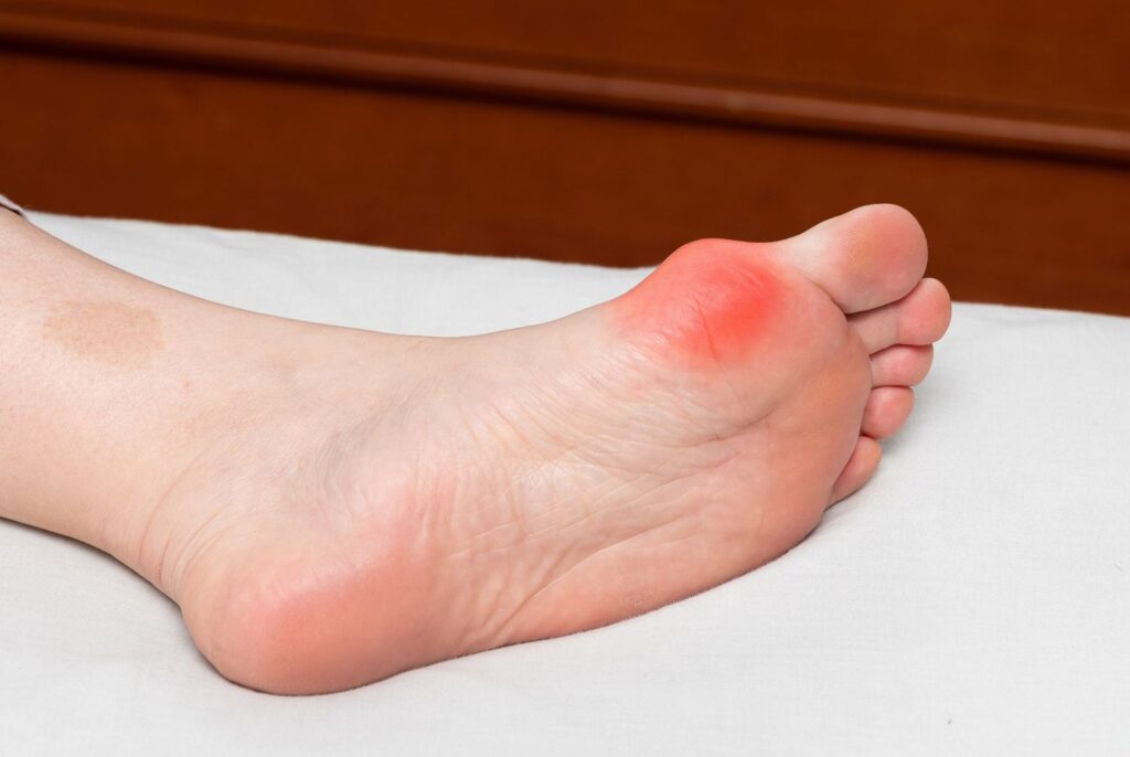 Inflamed bunion on sole of foot showing redness; consult bunion treatment doctors cypress for relief