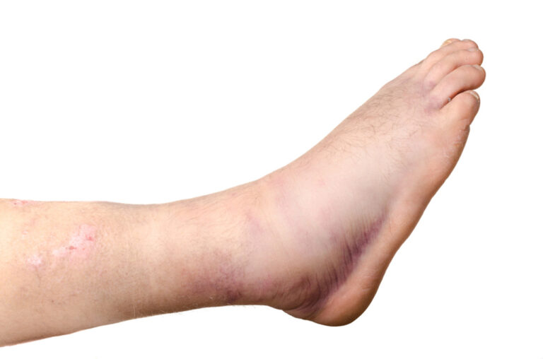 Bruised arch and irritated skin assessment; Wharton’s Jelly Podiatrist Houston provides regenerative foot and leg care.