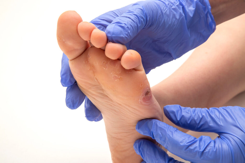 Cash pay podiatrist examining dry, cracked sole with painful foot ulcer to provide specialized treatment without insurance