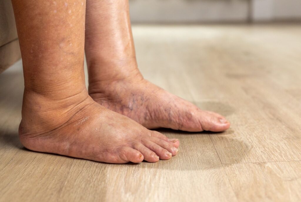 Swollen feet and ankles caused by diabetic edema. Learn about proper diabetic foot care doctor cypress recommendations.
