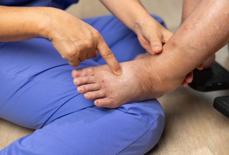 A medical professional examining pitting edema on a patient's foot. Get expert diabetic foot care doctor cypress examinations.