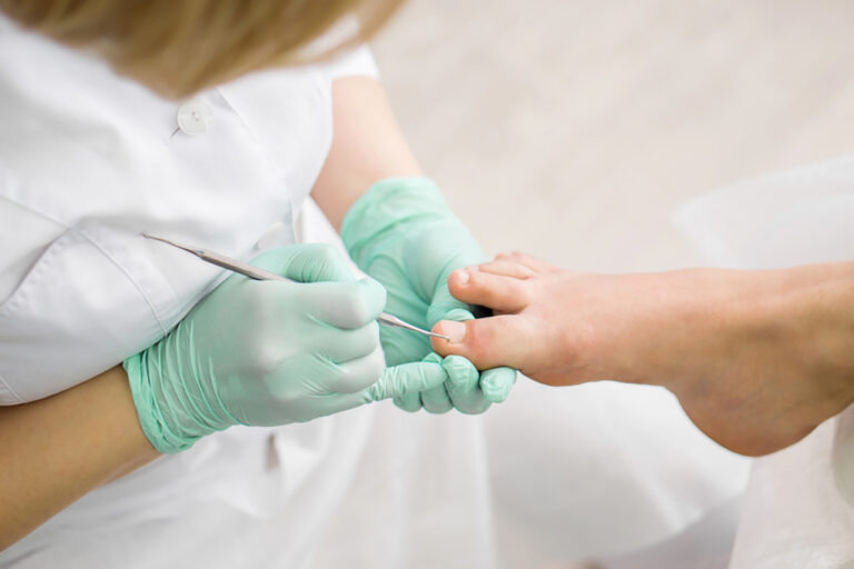 Podiatry toenail treatment by gloved clinician, careful nail cleaning and ingrown care for bunion surgery recovery support.