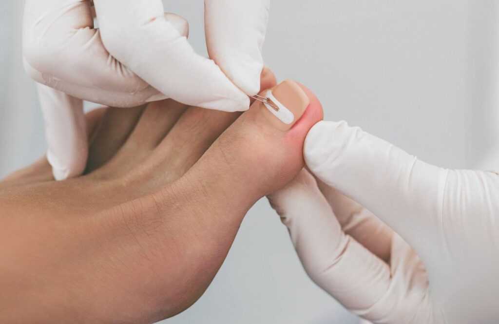 Professional Podiatrist Ingrown Toenail Cypress treatment using a corrective nail brace to fix curved growth.