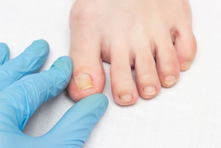 Close-up of a Podiatrist Ingrown Toenail Cypress expert performing a medical foot exam on a patient in a sterile clinic.