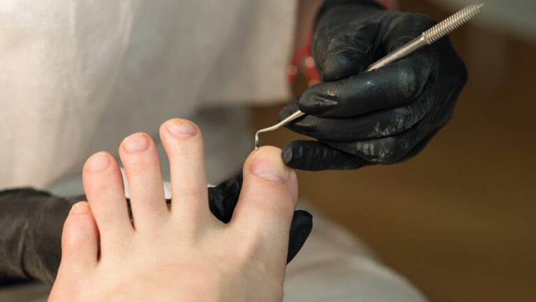 Expert Podiatrist Ingrown Toenail Cypress specialist performing a precise medical procedure to relieve toe pain.