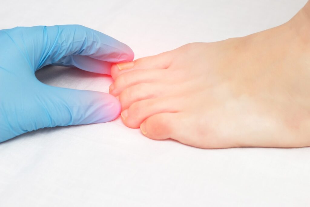 Professional Podiatrist Ingrown Toenail Cypress evaluation of a patient's foot to determine the best clinical treatment.