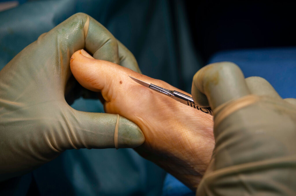 Precise surgical incision performed on a patient at a Podiatry Clinic Cypress to treat chronic foot pain and injuries.