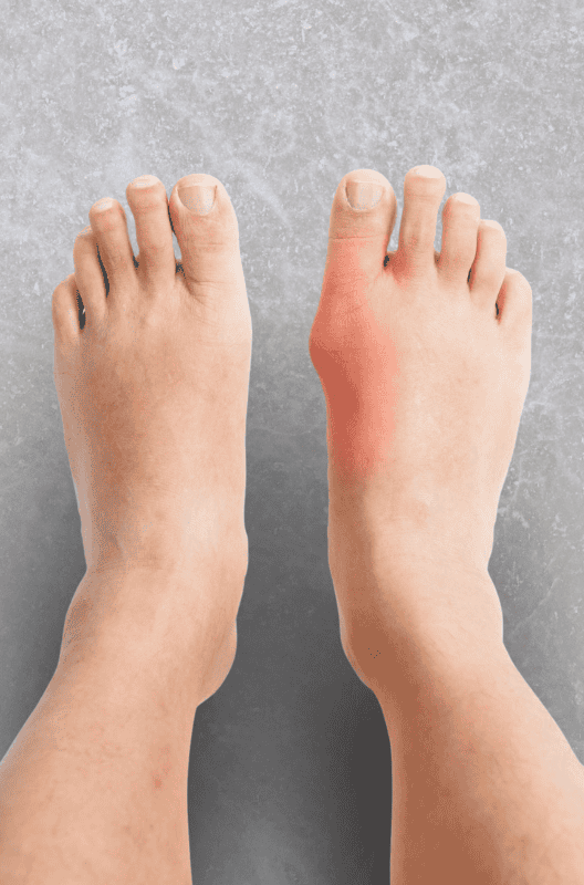 Bunion deformity on the big toe of the foot