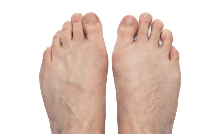 Visual guide to common foot deformities from bunion treatment doctors Cypress showing hallux valgus symptoms.