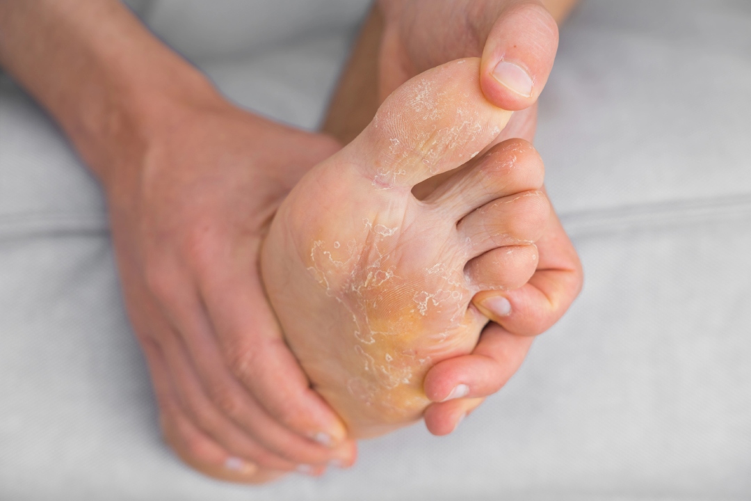 Patient receiving exam from a foot specialist for fungus Cypress to treat peeling skin on the sole and toes.