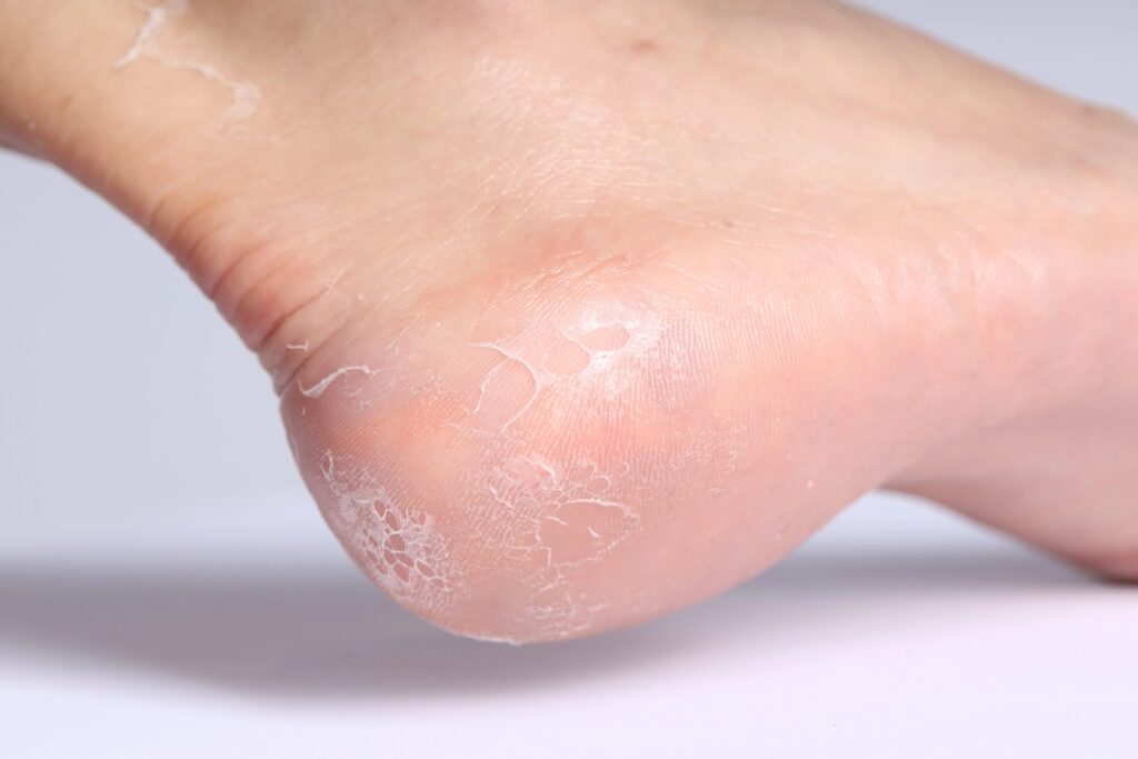 Close up of dry cracked heel skin needing a foot specialist for fungus Cypress to diagnose and treat infection.