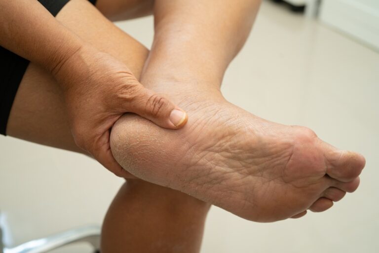 Heel pain doctor Cypress podiatry consultation for patient experiencing sharp stabbing pain in the lower heel.