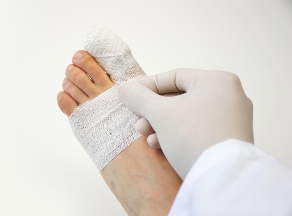 A specialist at a wound care clinic Houston applies a protective net dressing to a patient's injured big toe in a sterile setting.