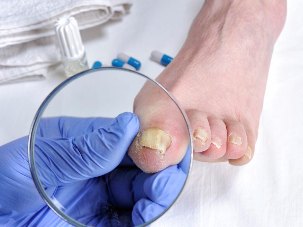 Podiatrist using a magnifying glass for toenail fungus treatment Cypress to examine infected yellow nails.