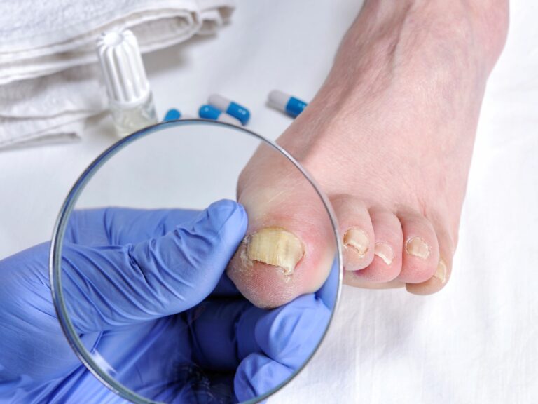 Podiatrist using a magnifying glass for toenail fungus treatment Cypress to examine infected yellow nails.