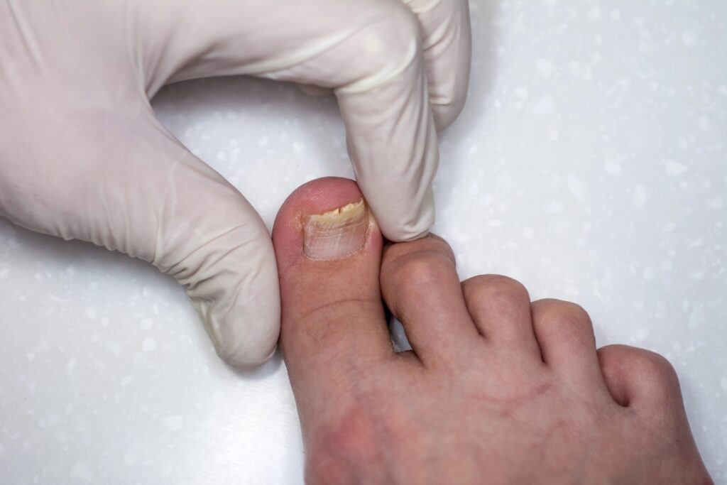 Medical specialist examining infected big toe for toenail fungus treatment Cypress on a white background.