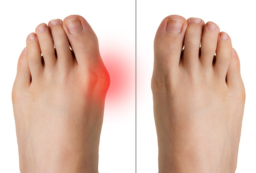Experience relief with specialized care from bunion treatment doctors in Cypress to resolve chronic pain and inflammation.