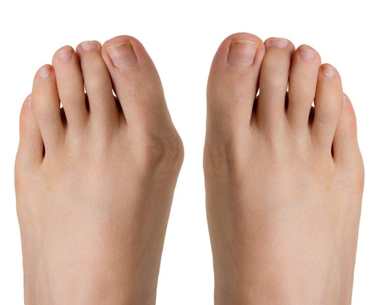 Visualize the symptoms of bunion and get a professional diagnosis from top bunion treatment doctors in Cypress today.