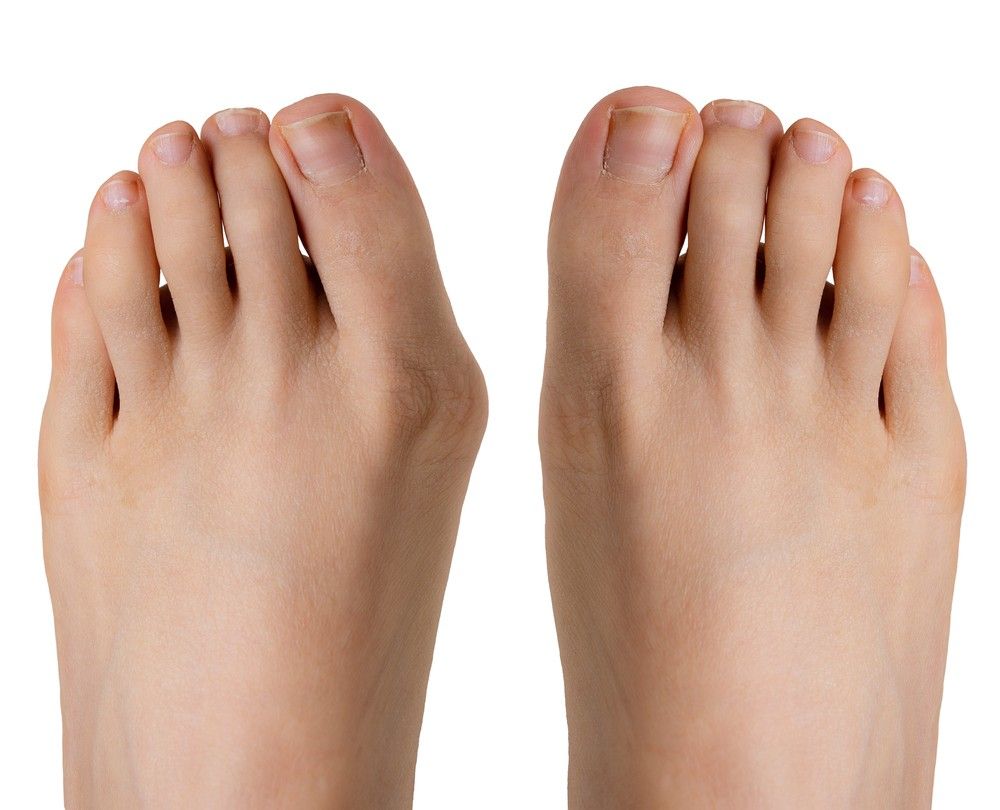 Visualize the symptoms of bunion and get a professional diagnosis from top bunion treatment doctors in Cypress today.